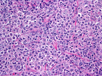 Follicular lymphoma, grade 3B 9