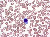 hairy-cell-leukemia-cladribine-with-concurrent-rituximab-may-improve