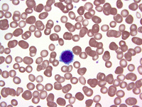 hairy-cell-leukemia-3