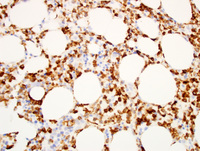 Hairy cell leukemia 4