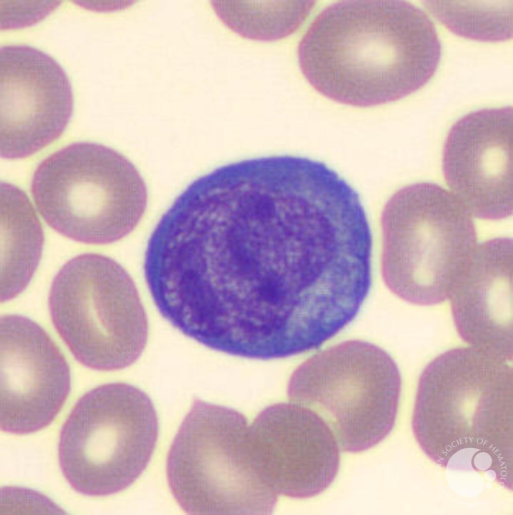 Reactive lymphocyte