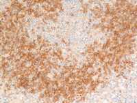 Plasmacytoid dendritic cells-CD123 stain