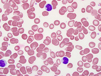 Hepatosplenic T cell lymphoma 1