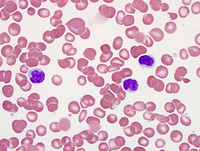 Hepatosplenic T cell lymphoma 2