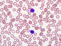 Chronic lymphoproliferative disorder of NK cells 1