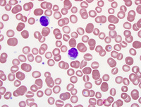 Chronic lymphoproliferative disorder of NK cells 3