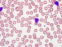 Chronic lymphoproliferative disorder of NK cells 4