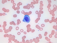 Plasma cell leukemia 2