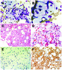 Familial hypertriglyceridemia manifests with pancytopenia and bone marrow pseudo–Niemann-Pick cells