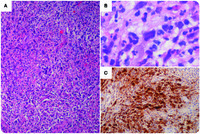 Herpes simplex virus lymphadenitis