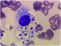 Disseminated cryptococcosis in bone marrow