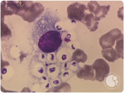 Disseminated cryptococcosis in bone marrow