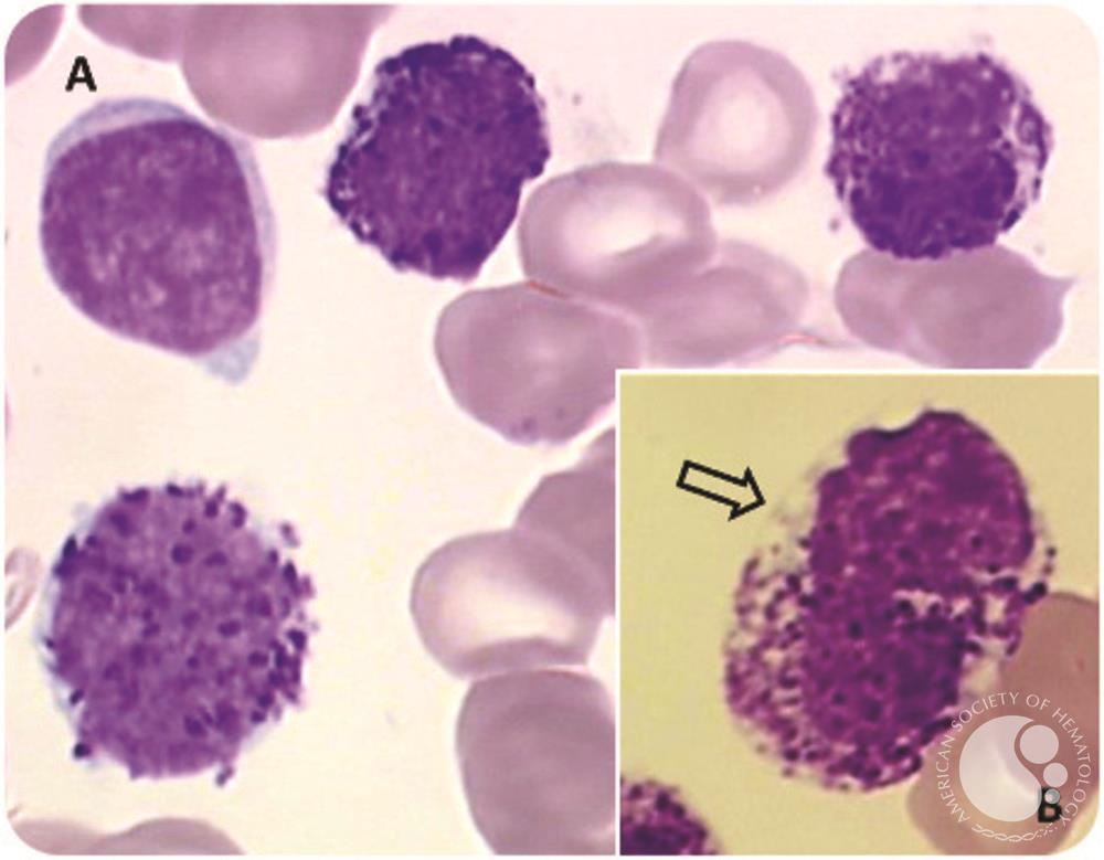 Acute basophilic leukemia