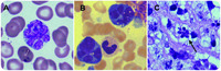 Diffuse large B-cell lymphoma in leukemic phase with flower cell morphology