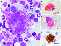 Giant multilobated mastocytes (promastocytes) in the setting of a refractory acute myeloid leukemia with myelodysplasia-related changes and monosomal karyotype