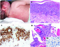 Langerhans cell histiocytosis with atypical histiocytic marrow infiltration