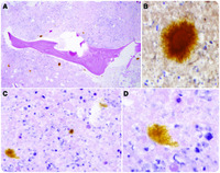 Hematoidin