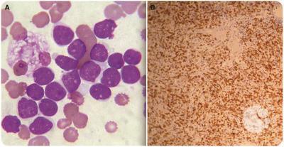 Diffuse large B-cell lymphoma in leukemic phase
