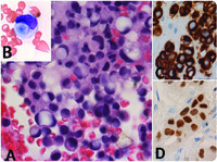 Metastatic lobular breast carcinoma mimicking multiple myeloma