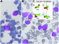 Sequential development of different acute leukemia types in the same patient