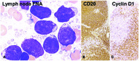 Granular lymphoid cells are not always part of T-cell lineage: an atypical case of mantle cell lymphoma