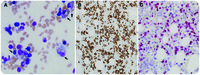 EBV-positive peripheral T-cell lymphoma with extensive hemophagocytosis