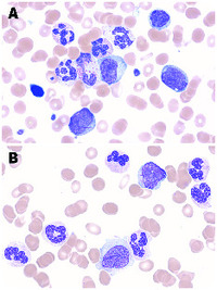 Auer rods in a patient with chronic myelomonocytic leukemia type 2