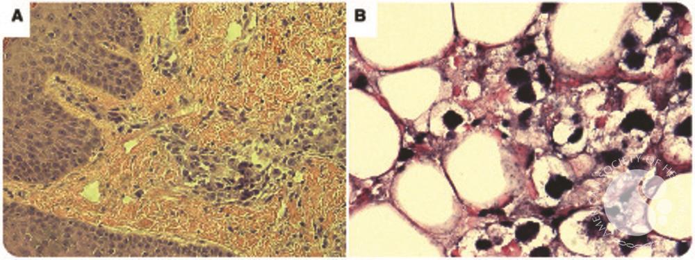 EBV-driven HIV-associated diffuse large B-cell lymphoma causing profound lactic acidosis