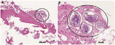 Schistosomal eggs identified on bone marrow biopsy