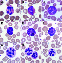 Nuclear hypersegmentation of neutrophils, eosinophils, and basophils due to hydroxycarbamide (hydroxyurea)