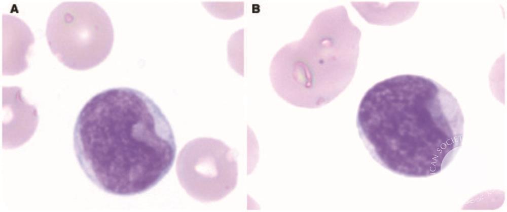 “Cup-like” blasts in acute myeloid leukemia with FLT3 and NPM1 mutations