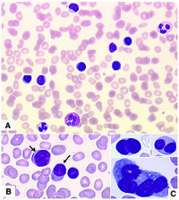 Atypical plasma cell leukemia mistaken for lymphocytosis on blood count