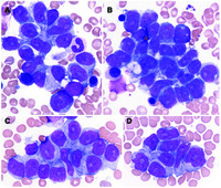 Hepatosplenic T-cell lymphoma mimicking bone marrow metastasis