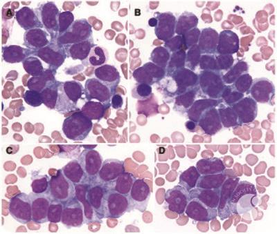 Hepatosplenic T-cell lymphoma mimicking bone marrow metastasis