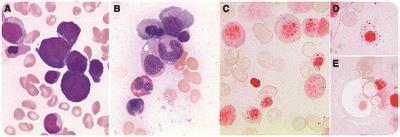 Vitamin B deficiency presenting as pancytopenia with ring sideroblasts