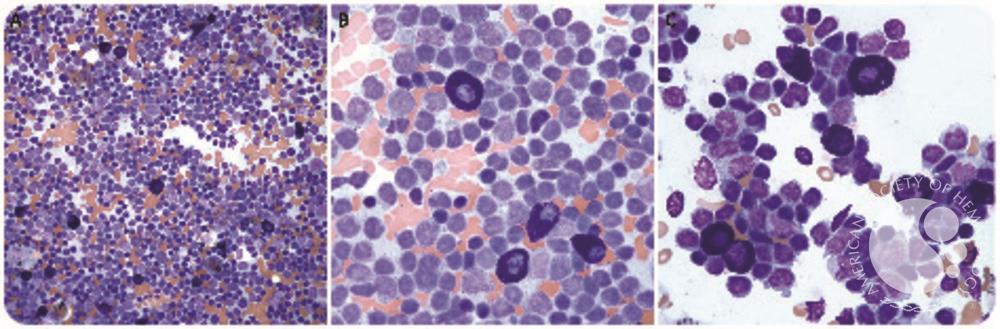 Lymphoplasmacytic lymphoma with prominent mast cell infiltrates