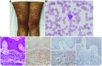 Adult T-cell leukemia/lymphoma