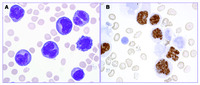 Primary effusion lymphoma