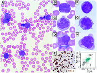 Pediatric blastic plasmacytoid dendritic cell neoplasm, acute leukemic variant