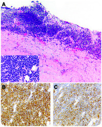 Pericardial involvement by chronic lymphocytic leukemia/small lymphocytic lymphoma