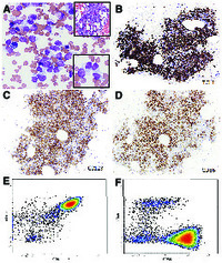 Disseminated blastic plasmacytoid dendritic cell neoplasm