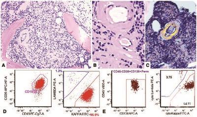 Systemic AL amyloidosis associated with Waldenström macroglobulinemia: an unusual presenting complication