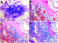 Gelatinous transformation of the bone marrow from anorexia nervosa