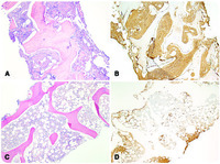 Resolution of osteosclerosis after alloHCT in systemic mastocytosis