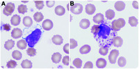 Peripheral blood findings in GM1 gangliosidosis