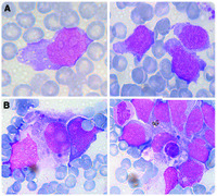 Hepatosplenic Tcell lymphoma an acute leukemia presentation