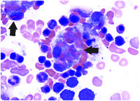 Hemophagocytosis in a patient with sickle cell disease