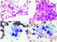 hemophagocytic-lymphohistiocytosis-associated-with-visceral-leishmaniasis