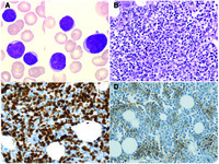 Pure red cell aplasia revealing nonnodal mantle cell lymphoma