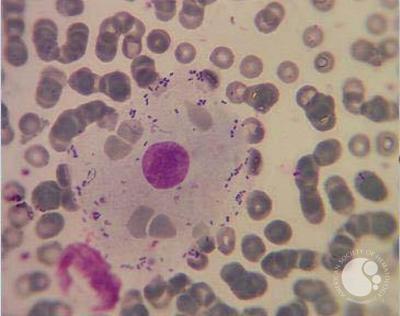 Diplococcus Laden Epithelial Cells in Peripheral Blood Smear of a Patient with Leukocytosis